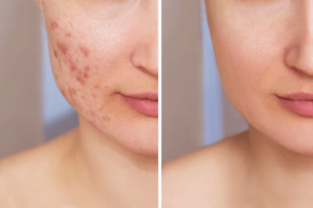 pele com acne antes e depois